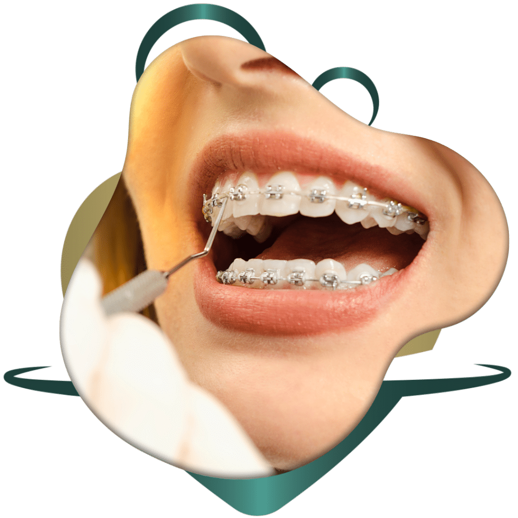 خصومات تقويم أسنان معدني بالطائف